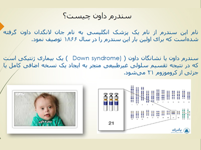 سندروم داون