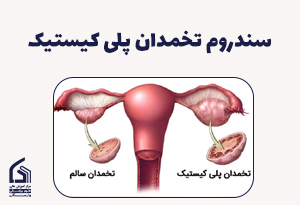 سندروم تخمدان پلی کیستیک