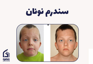 سندرم نونان: یک نقص ژنتیکی، با اثرات زنجیره‌ای روی رشد!